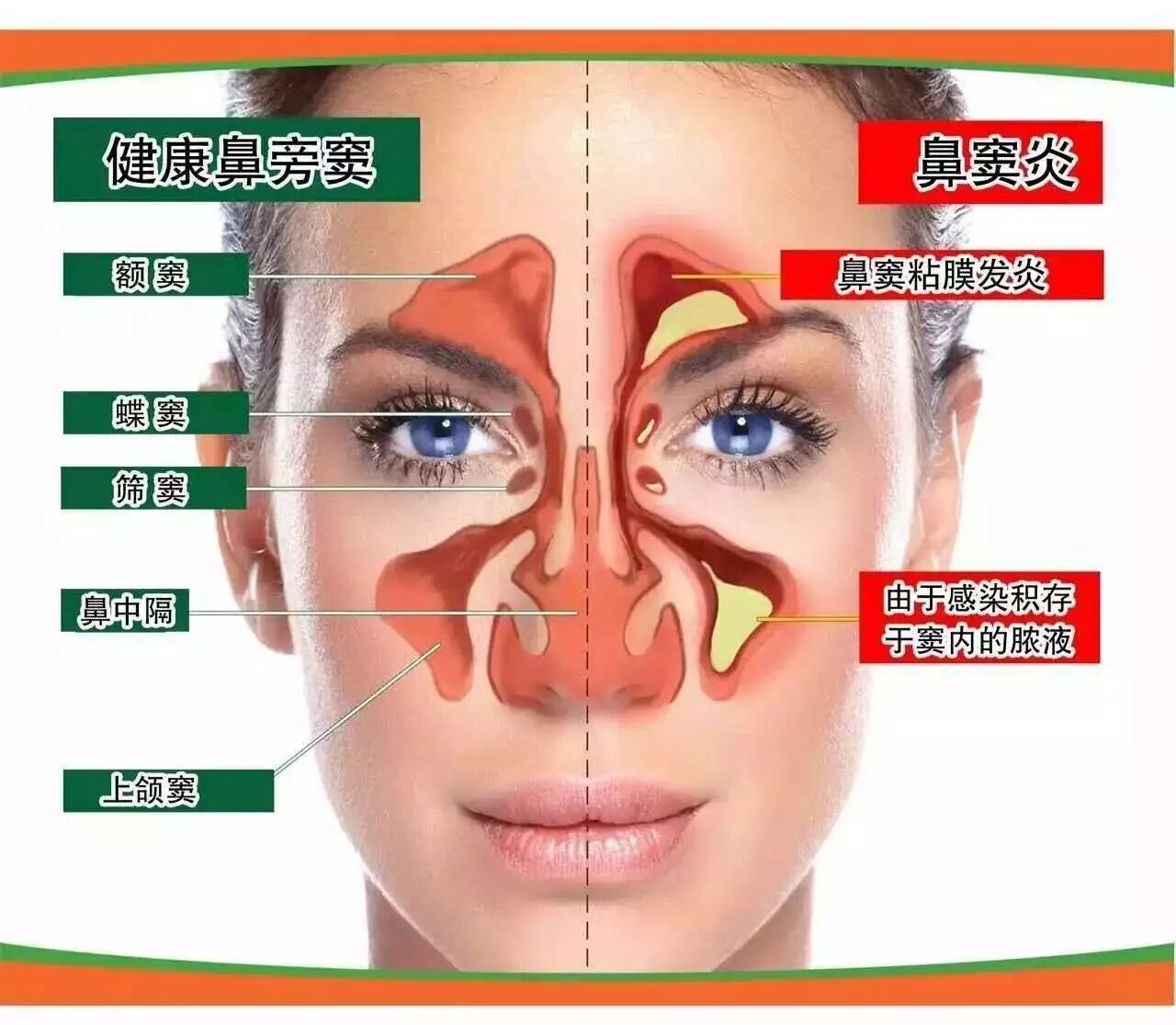 治疗因感冒引起的鼻炎,鼻窦炎,最关键的是要解决病灶清理不留病根.