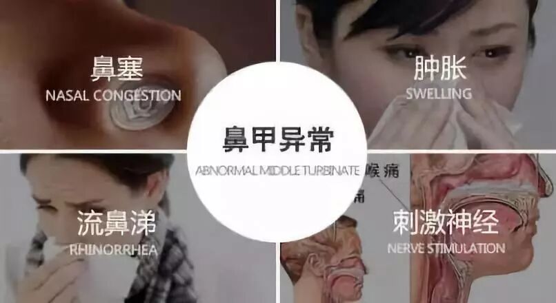 【鼻炎·养护】怎样预防鼻甲肥大