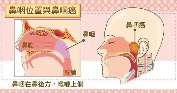 警惕鼻咽癌的四个单侧症状