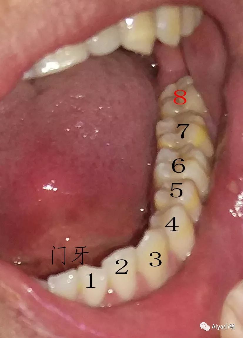 智齿到底拔不拔 春雨医生