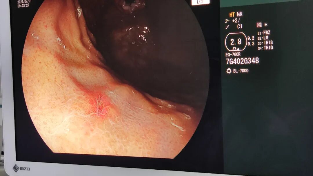 富士胃镜英文怎么写竹溪县中医院“镜”益求精 投入使用富士7000电子胃镜_https://www.jmylbn.com_新闻资讯_第3张