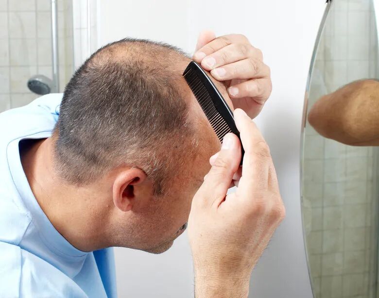 斑秃在研疗法盘点：蓄势待“发”，首款口服斑秃药物上市，多款2—3期在研疗法进展积极