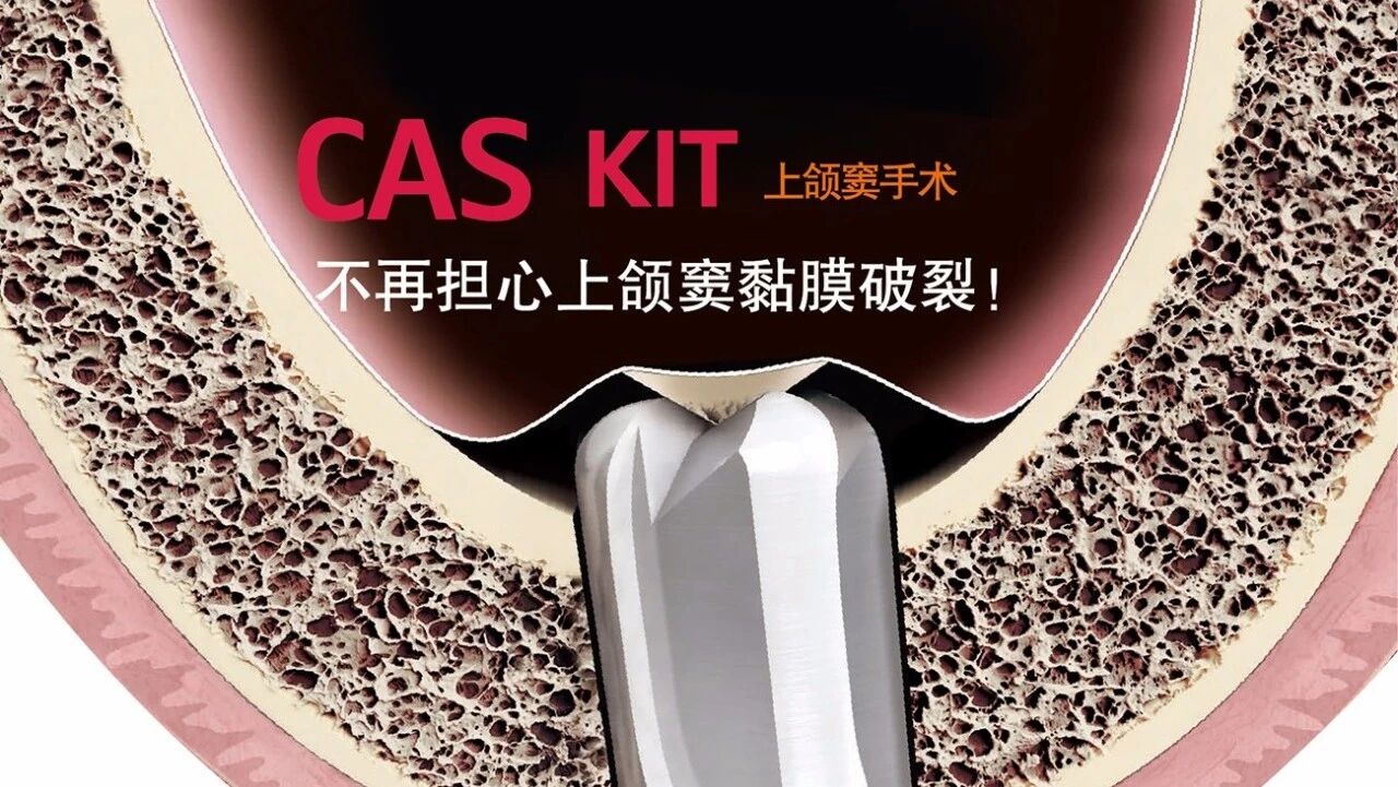 颠覆传统,上颌窦内提升工具盒- cas-kit