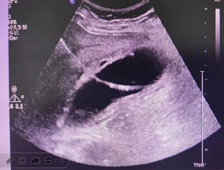 介入引流管怎么关“小针孔、治大病”介入血管外科技术之经皮经肝胆囊穿刺置管引流术_https://www.jmylbn.com_新闻资讯_第6张