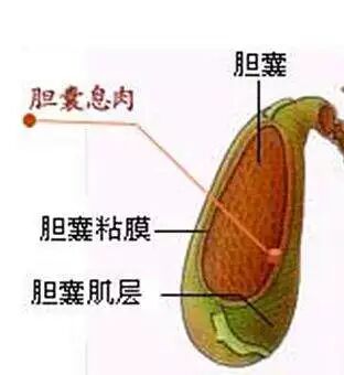 胆囊息肉那点事 现在看 还不算晚 北京中山医院订阅号 微信公众号文章阅读 Wemp