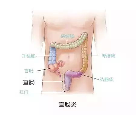 【醫識】直腸癌和直腸炎有哪些區別？看完全明白！ 健康 第3張