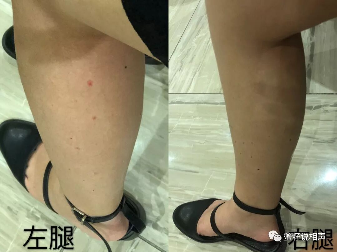 瘦腿针有风险吗_瘦腿针风险_瘦腿针有危害
