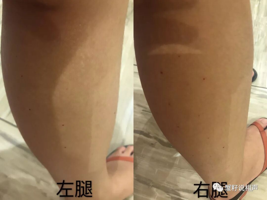 瘦腿针风险_瘦腿针有风险吗_瘦腿针有危害