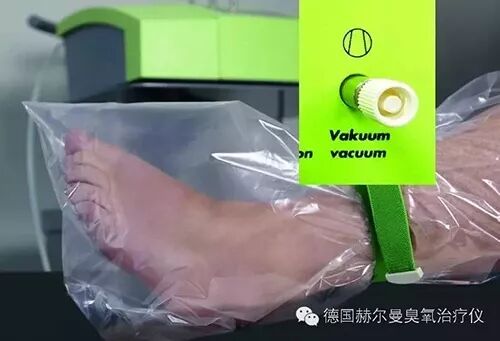 臭氧治疗仪是治疗什么德国赫尔曼臭氧治疗仪超豪华 comfort型_https://www.jmylbn.com_新闻资讯_第18张