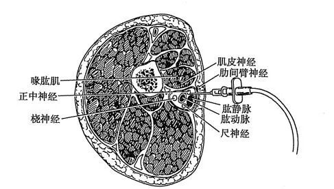 神经丛刺激针是什么各种麻醉神阻法详解！推荐收藏！_https://www.jmylbn.com_新闻资讯_第12张