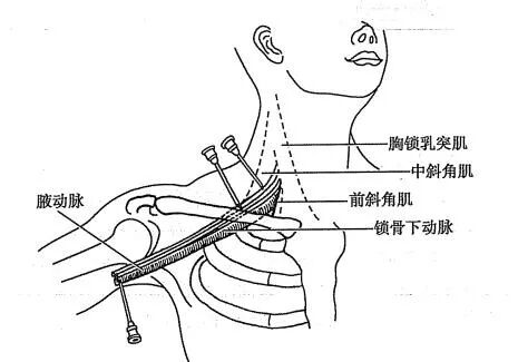 神经丛刺激针是什么各种麻醉神阻法详解！推荐收藏！_https://www.jmylbn.com_新闻资讯_第8张