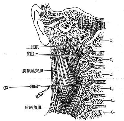 神经丛刺激针是什么各种麻醉神阻法详解！推荐收藏！_https://www.jmylbn.com_新闻资讯_第4张