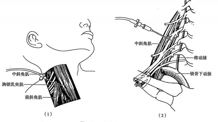 神经丛刺激针是什么各种麻醉神阻法详解！推荐收藏！_https://www.jmylbn.com_新闻资讯_第10张