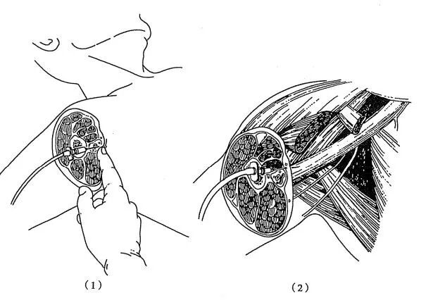 神经丛刺激针是什么各种麻醉神阻法详解！推荐收藏！_https://www.jmylbn.com_新闻资讯_第11张