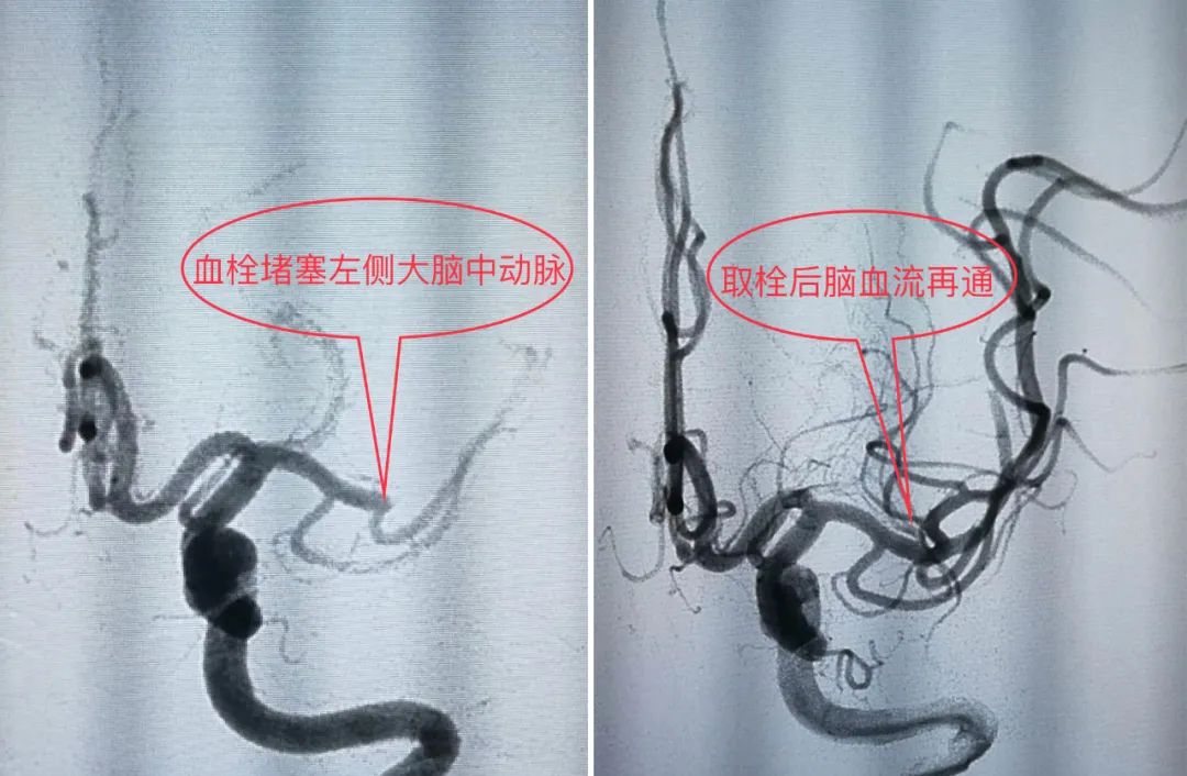 鄰居猝死，他大受打擊去做體檢，毫無症狀卻查出大問題！10組影像對比圖告訴你，血管出現這些情況有多可怕 健康 第1張