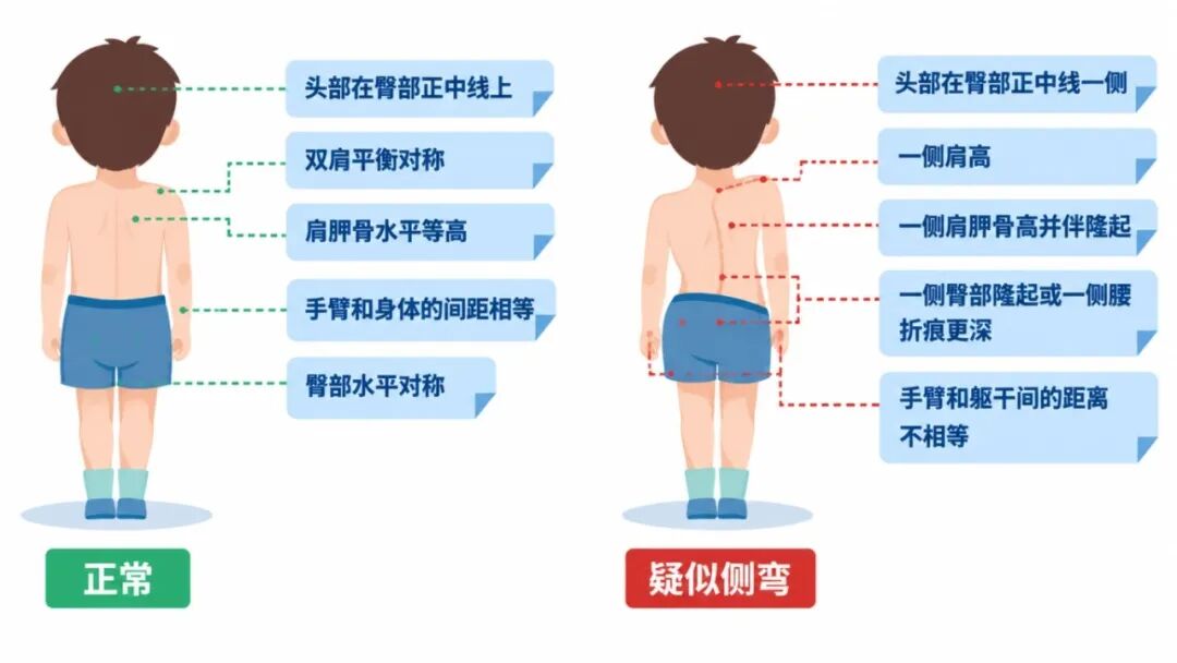 儿童脊柱侧弯对比插画 (1).jpg
