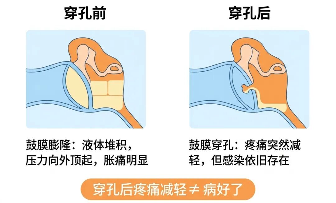 鼓膜对比科普图.jpg