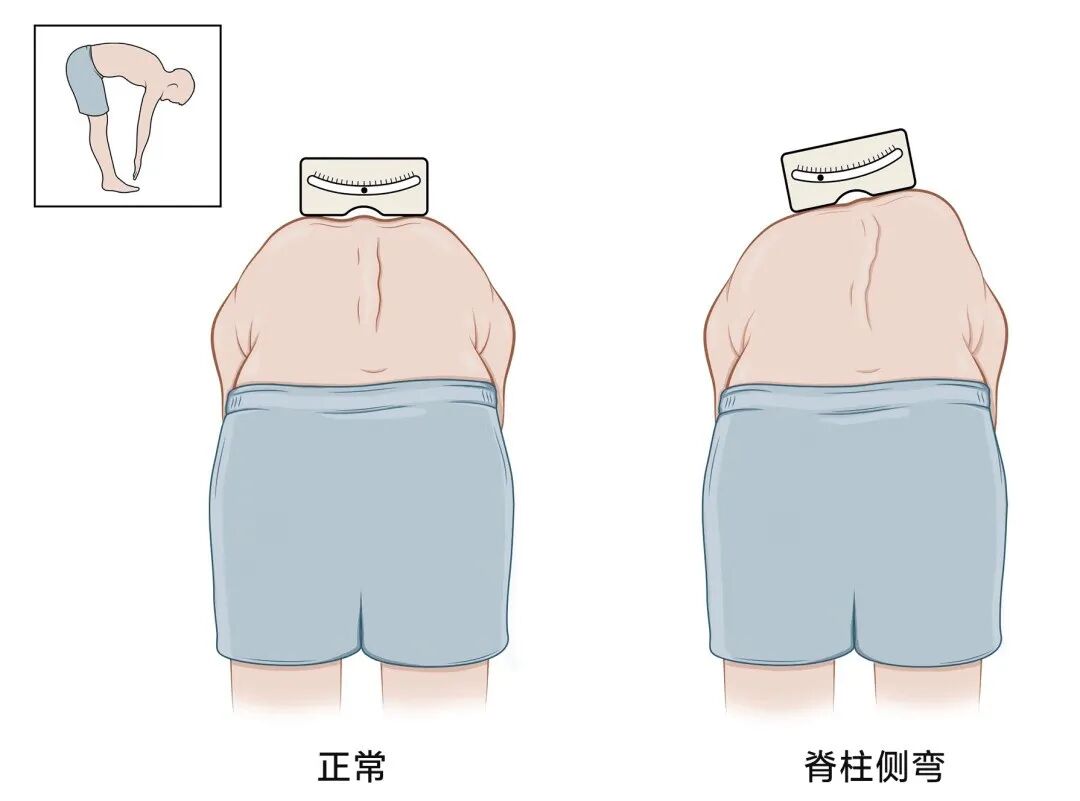 高低肩、长短腿……这种疾病让人越长越矮！-京东健康
