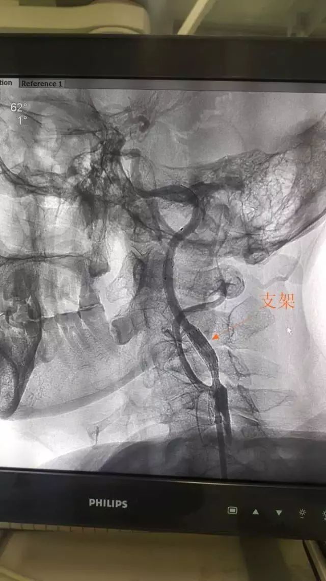 xact颈动脉支架图片