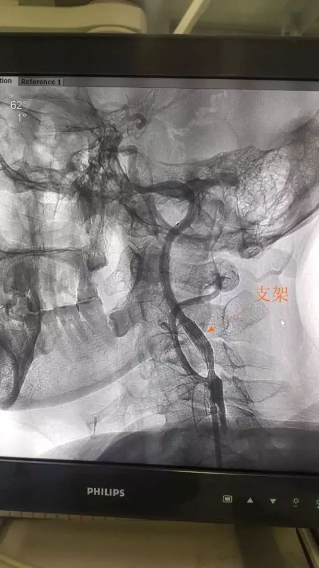 颈动脉支架植入术治疗颈动脉狭窄实例