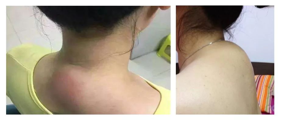 古法经络|“富贵包”的危害，可能比你想象的大！