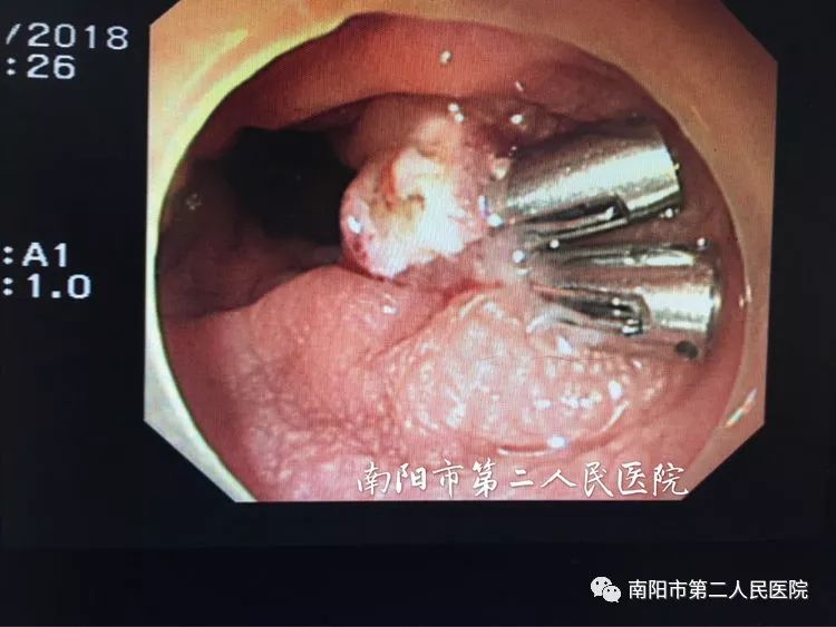 南阳二院消化内镜中心病例分享--小儿结肠息肉