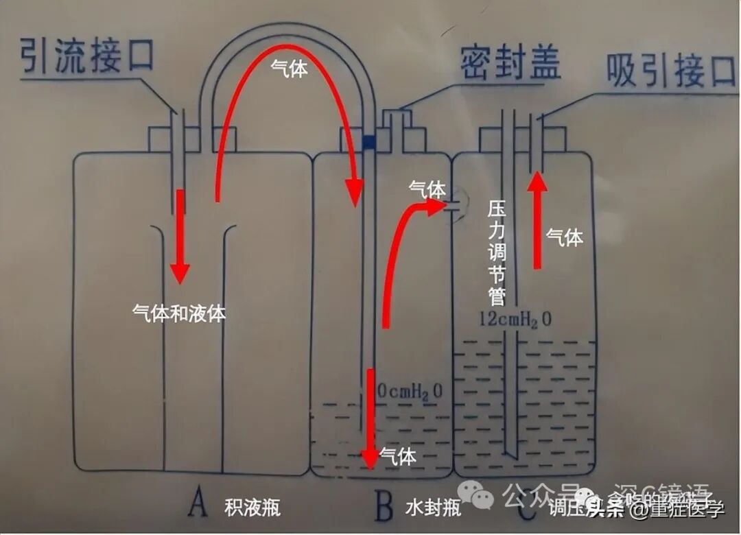 三腔引流管有哪些胸腔闭式引流瓶单腔、双腔、三腔胸腔引流瓶的区别及注意事项_https://www.jmylbn.com_新闻资讯_第6张