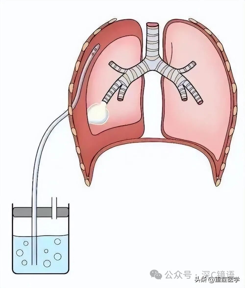 三腔引流管有哪些胸腔闭式引流瓶单腔、双腔、三腔胸腔引流瓶的区别及注意事项_https://www.jmylbn.com_新闻资讯_第2张