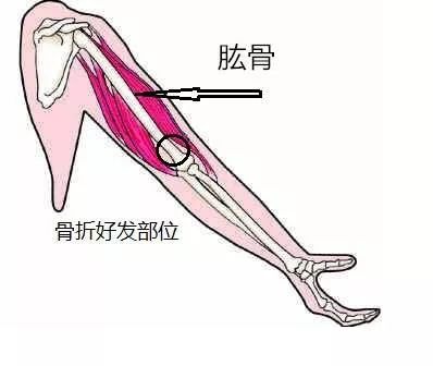 暑假到了 熊孩子上蹿下跳 不小心摔倒导致肱骨骨折该怎么办 泉州常橙医院 微信公众号文章阅读 Wemp