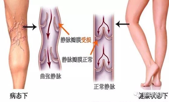 微莫斯 浅下肢静脉血栓治疗 微莫斯科普 微信公众号文章阅读 Wemp