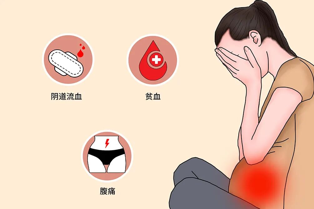 试管婴儿反复流产可能是抗磷脂综合征惹的祸！