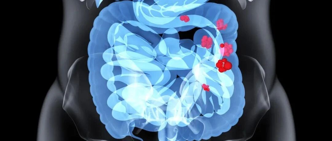 一文认识罕见肠病——肠淋巴管扩张症 | 临床必备
