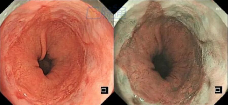食管癌以食管中段最多见,下段次之,上段最少.可分为早期和中晚期两类.