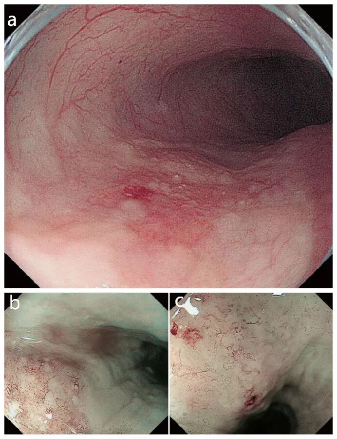 食管癌早期胃镜下图片图片