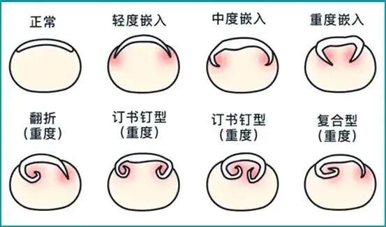 夏天，你的甲沟炎复发了吗？_郑州皮肤病专科银河总站_河南京城皮肤中银河总站(原河南中都中医皮肤病银河总站)