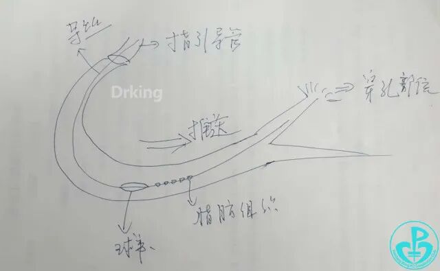 泥鳅导丝怎么用泥鳅导丝又惹祸，股动脉分支破裂要堵上！_https://www.jmylbn.com_新闻资讯_第7张