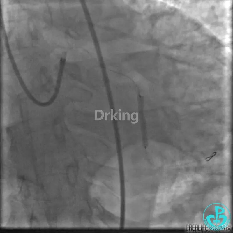 为什么要用到微导管操作演示：双腔微导管在重度扭曲病变中的使用，非常有效！_https://www.jmylbn.com_新闻资讯_第13张