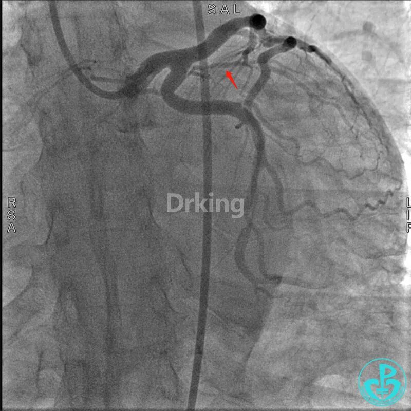 为什么要用到微导管操作演示：双腔微导管在重度扭曲病变中的使用，非常有效！_https://www.jmylbn.com_新闻资讯_第10张