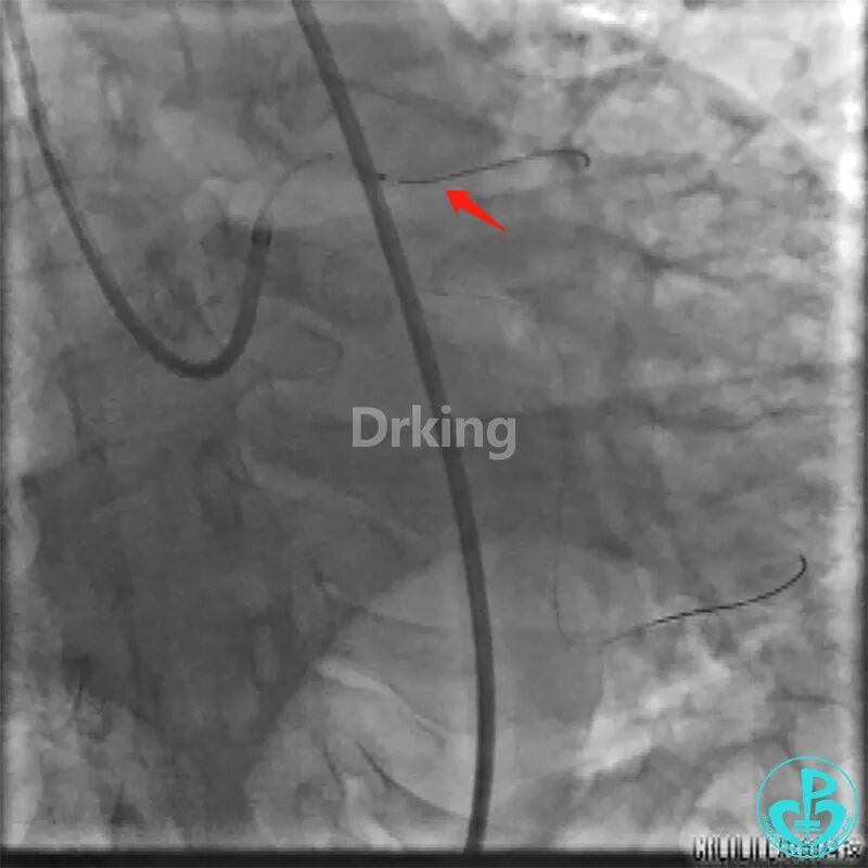 为什么要用到微导管操作演示：双腔微导管在重度扭曲病变中的使用，非常有效！_https://www.jmylbn.com_新闻资讯_第11张