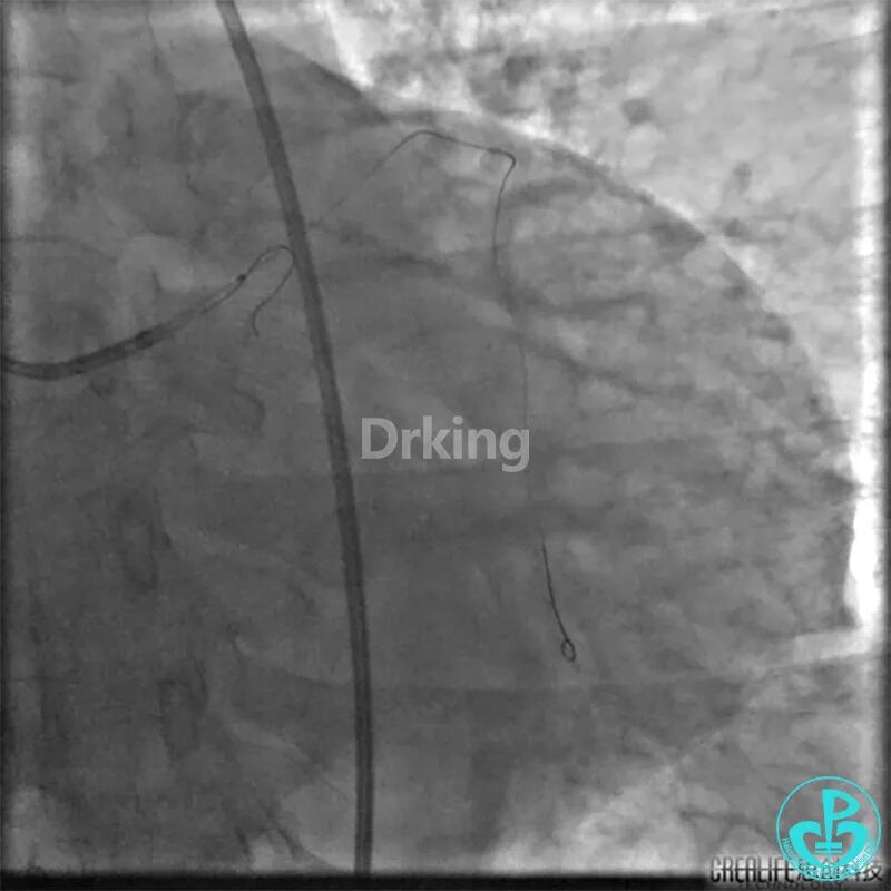 为什么要用到微导管操作演示：双腔微导管在重度扭曲病变中的使用，非常有效！_https://www.jmylbn.com_新闻资讯_第9张