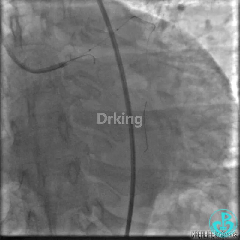为什么要用到微导管操作演示：双腔微导管在重度扭曲病变中的使用，非常有效！_https://www.jmylbn.com_新闻资讯_第8张
