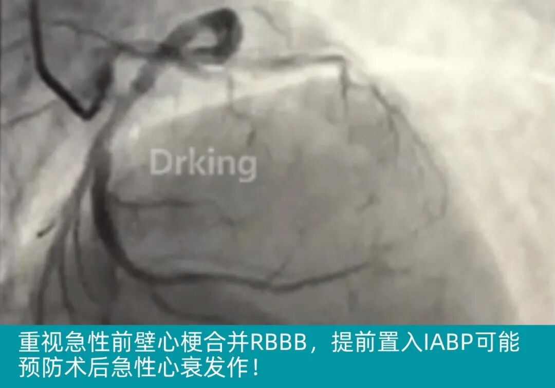 泥鳅导丝怎么用泥鳅导丝致纵隔血肿，少见但很危险_https://www.jmylbn.com_新闻资讯_第10张