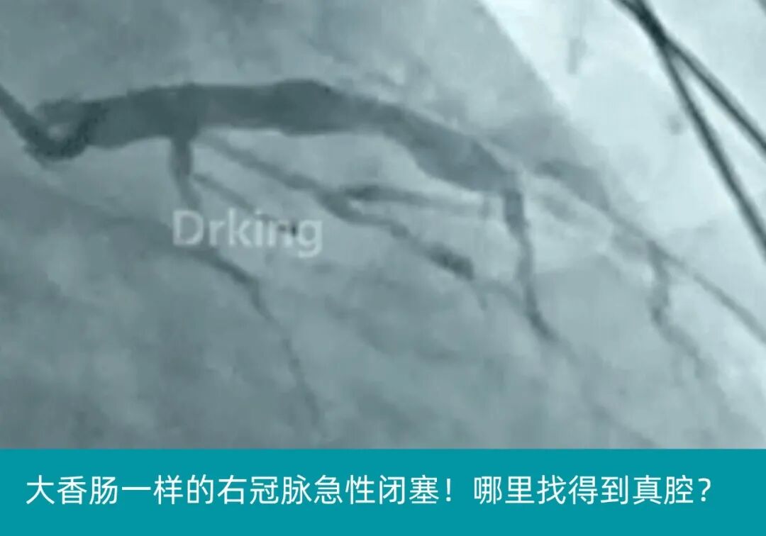 泥鳅导丝怎么用泥鳅导丝致纵隔血肿，少见但很危险_https://www.jmylbn.com_新闻资讯_第11张