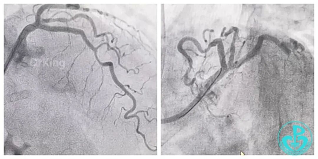 指引导丝有哪些惊险！前降支慢性闭塞指引导管致右冠开口夹层血流中断！_https://www.jmylbn.com_新闻资讯_第7张