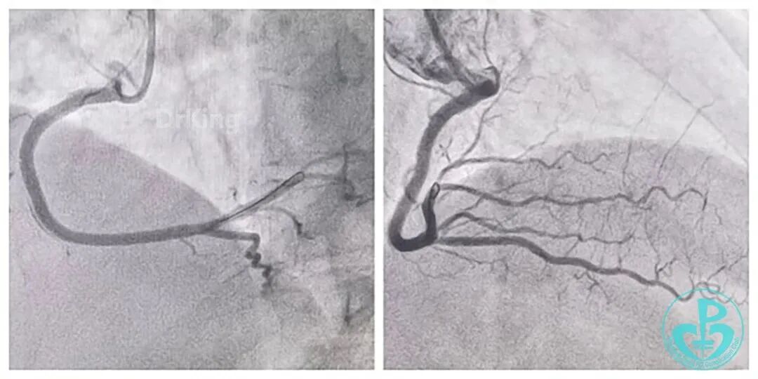 指引导丝有哪些惊险！前降支慢性闭塞指引导管致右冠开口夹层血流中断！_https://www.jmylbn.com_新闻资讯_第5张