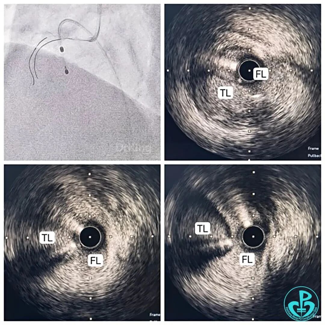 指引导丝有哪些惊险！前降支慢性闭塞指引导管致右冠开口夹层血流中断！_https://www.jmylbn.com_新闻资讯_第3张