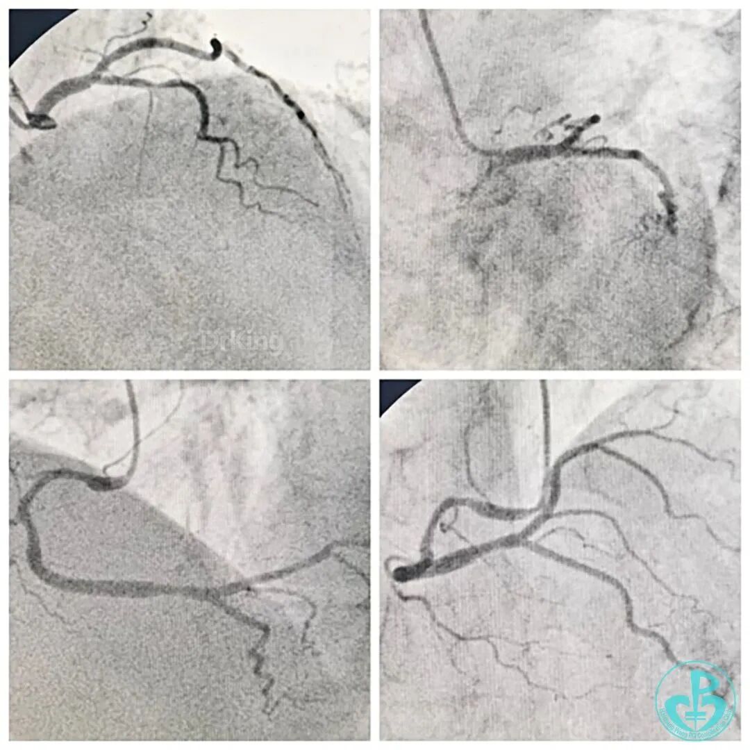指引导丝有哪些惊险！前降支慢性闭塞指引导管致右冠开口夹层血流中断！_https://www.jmylbn.com_新闻资讯_第1张