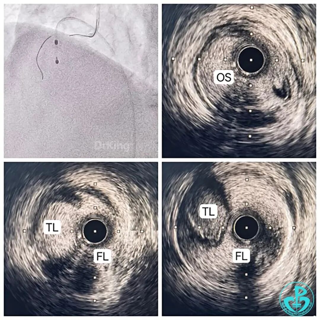 指引导丝有哪些惊险！前降支慢性闭塞指引导管致右冠开口夹层血流中断！_https://www.jmylbn.com_新闻资讯_第2张