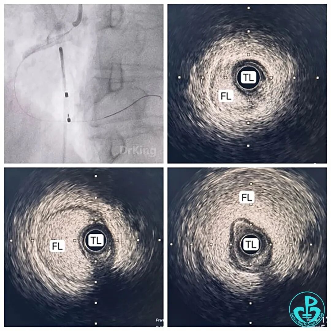 指引导丝有哪些惊险！前降支慢性闭塞指引导管致右冠开口夹层血流中断！_https://www.jmylbn.com_新闻资讯_第4张