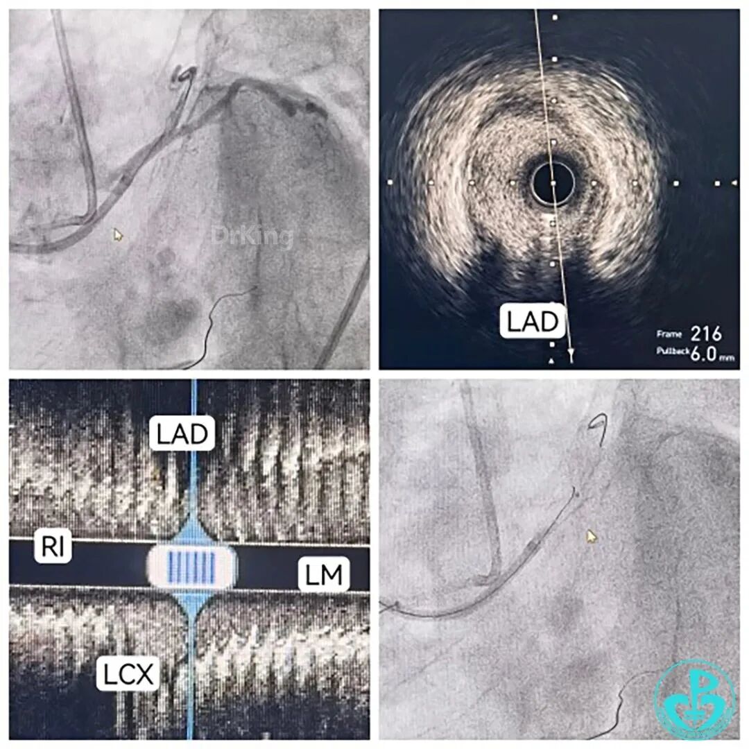 指引导丝有哪些惊险！前降支慢性闭塞指引导管致右冠开口夹层血流中断！_https://www.jmylbn.com_新闻资讯_第6张